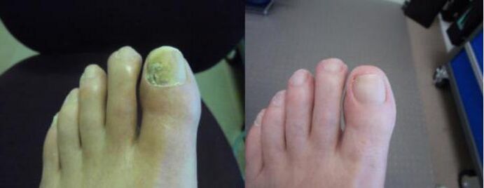 Photos des pieds avant et après l'utilisation de la crème Zenidol