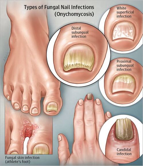 Types d'onychomycose